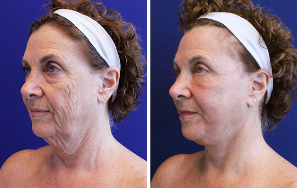 facelift and neck lift before and after palm beach