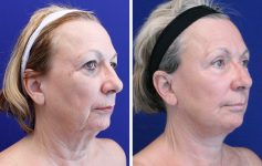 before and after female facelift palm beach