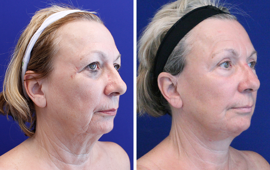 before and after female facelift palm beach