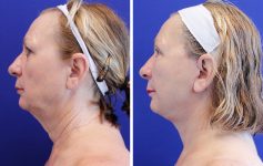 before and after female facelift left side profile