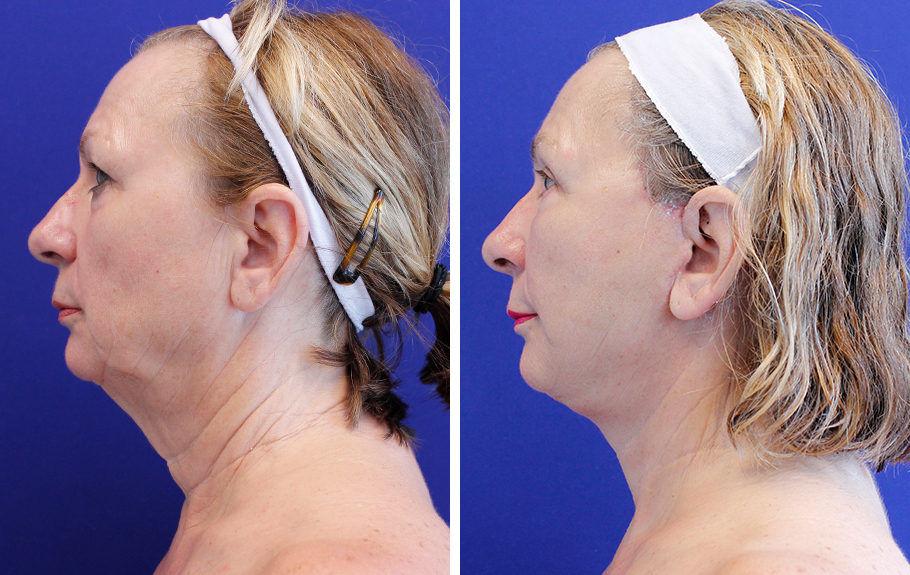 before and after female facelift left side profile