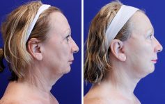before and after female facelift right side profile