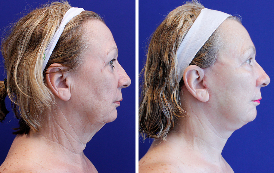 before and after female facelift right side profile