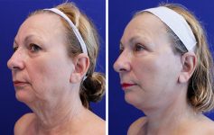 before and after female facelift left angle profile