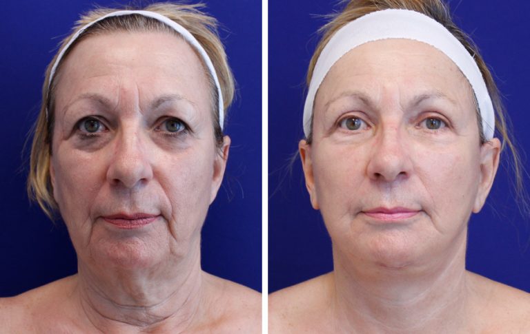 facelift before and after palm beach fl