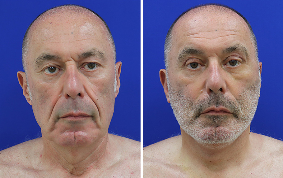 male facelift front facing before and after palm beach