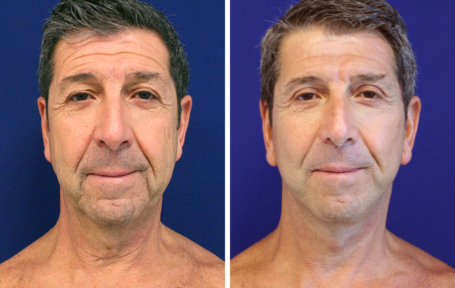 male-facelift-neck-lift--6694