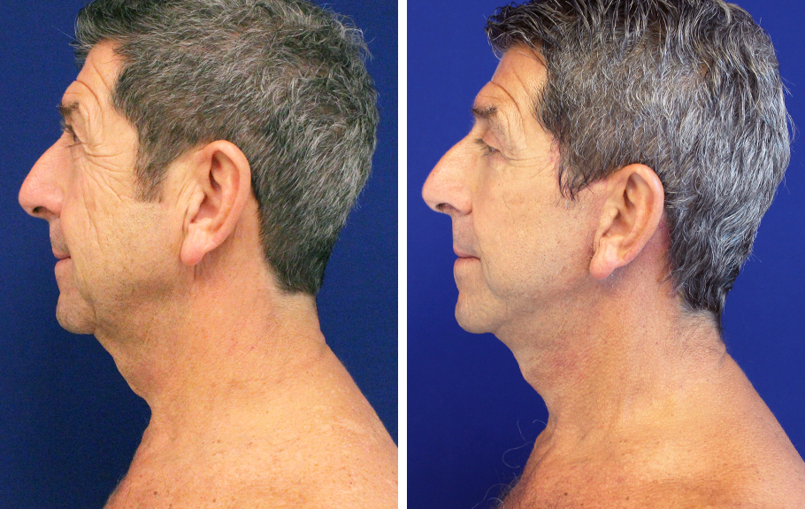 male-facelift-neck-lift--6695