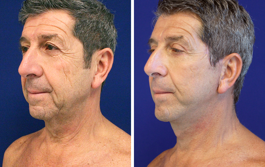 male-facelift-neck-lift--6696