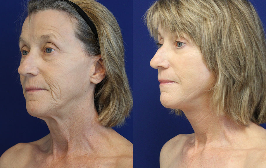 faceliftnecklift-with-fat-transfer-deep-plane-facelift-amp-neck-lift--5154