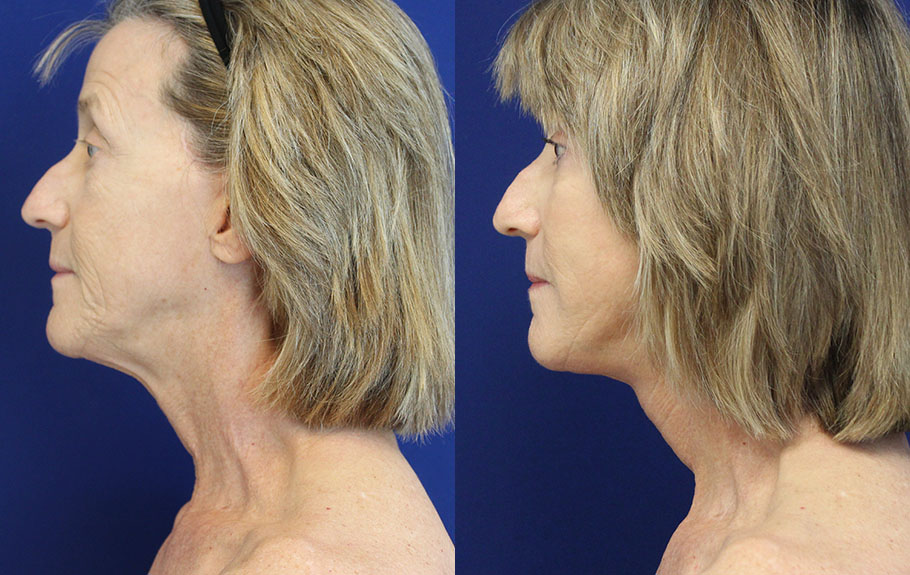 faceliftnecklift-with-fat-transfer-deep-plane-facelift-amp-neck-lift--5155