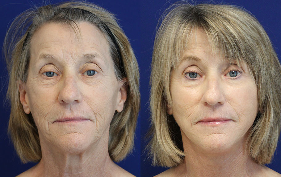 faceliftnecklift-with-fat-transfer-deep-plane-facelift-amp-neck-lift--5156