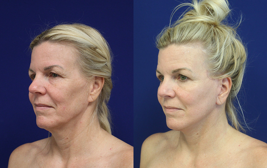 deep-plane-facelift-amp-neck-lift--7527