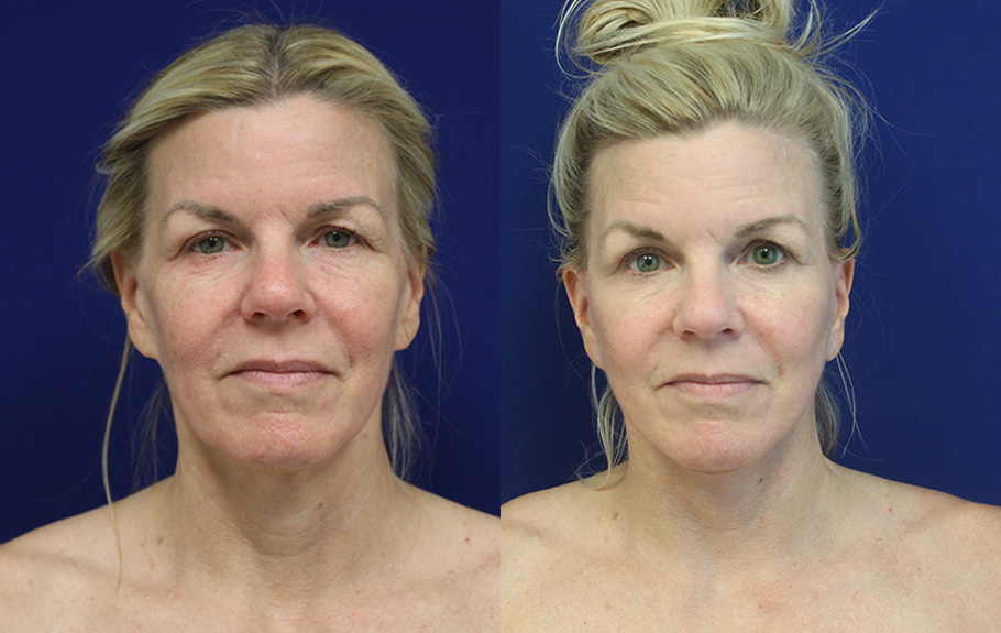 deep-plane-facelift-amp-neck-lift--7529