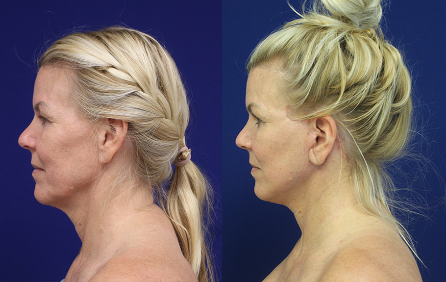 deep-plane-facelift-amp-neck-lift--7531